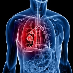 Air pollution causes lung cancer