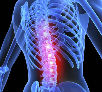 Delhi to run for spinal surgery awareness